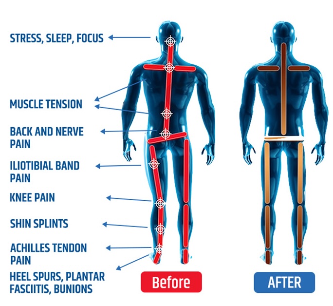 Before and after BioAlign orthotics — body alignment comparison