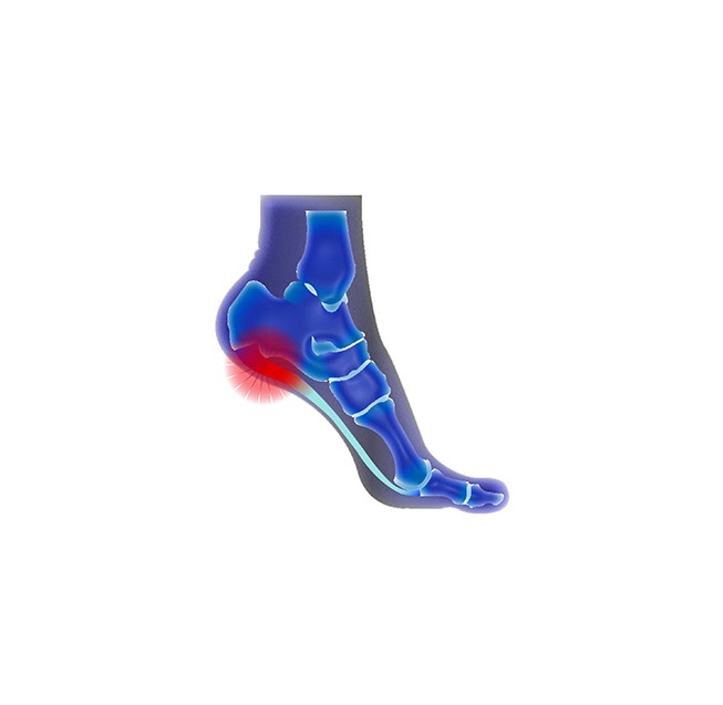 Plantar Fasciitis