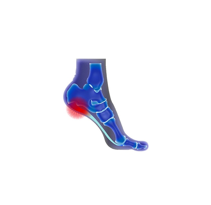 Plantar Fasciitis foot problem