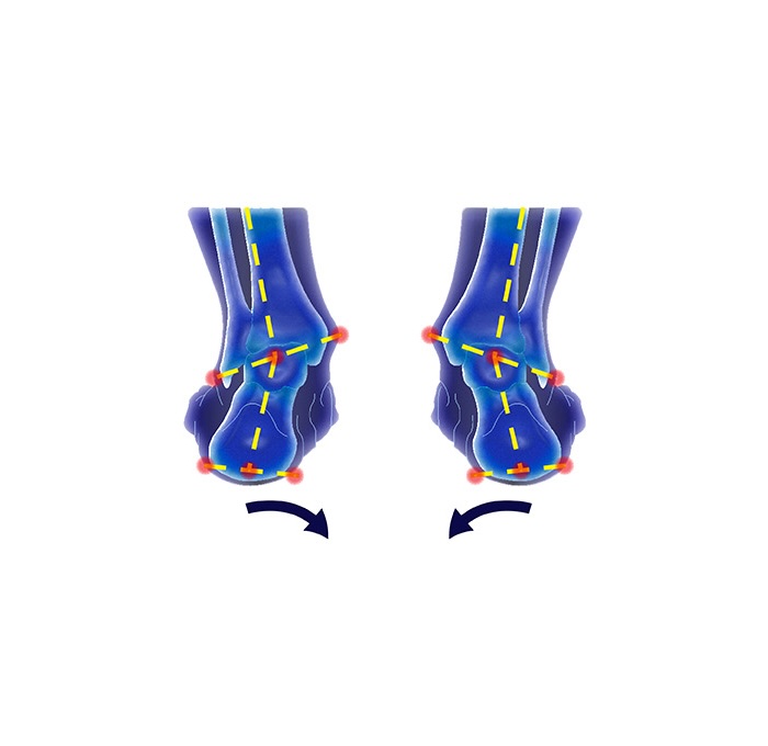 Pronation foot problem